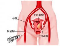 子宮栓塞介入手術(shù)過程